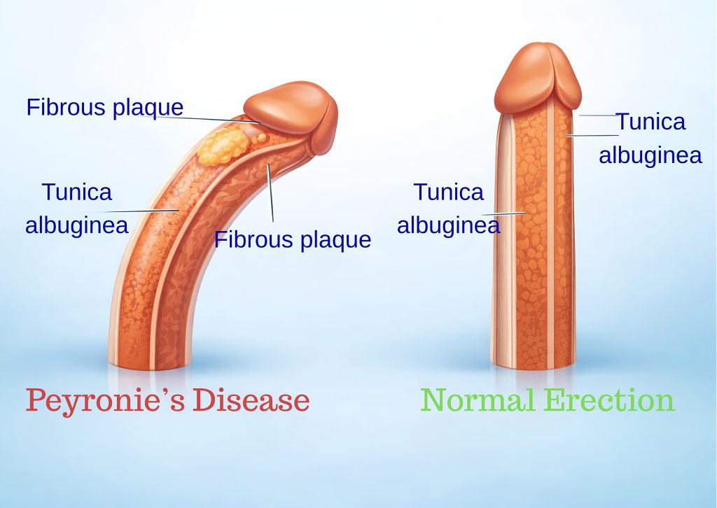 penile curvature